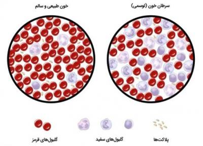 سرطان خون در بچه ها