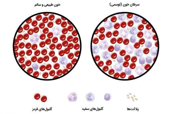 سرطان خون در بچه ها